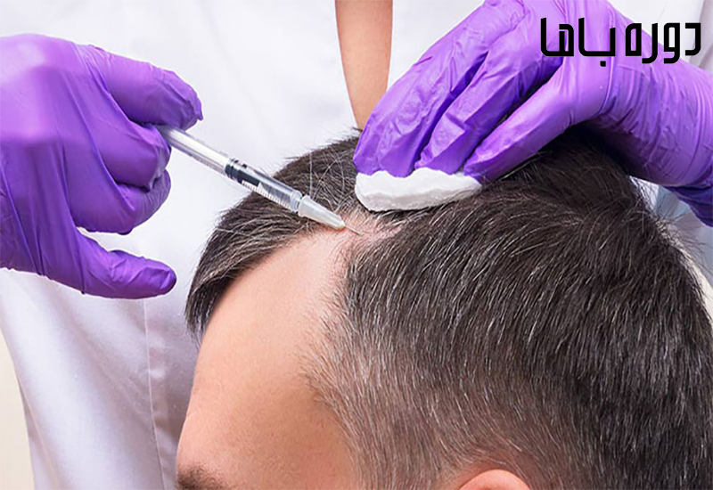 آموزش مزوتراپی مو