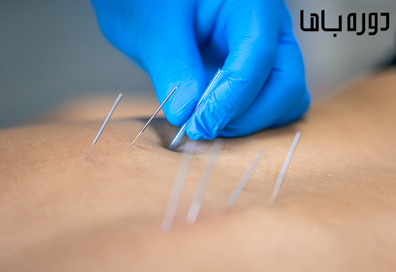 طب سوزنی برای لاغری