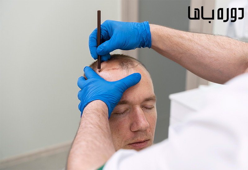 روش جدید کاشت مو