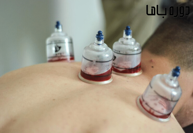 تفاوت حجامت و خون دادن