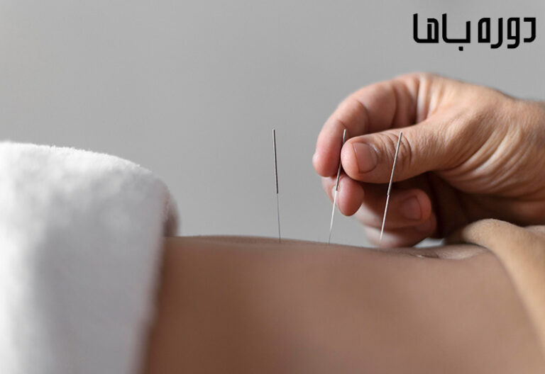 لاغری با طب سوزنی