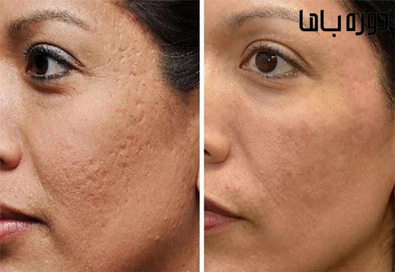 انواع روش‌های انجام میکرونیدلینگ