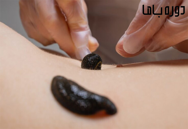 آموزش زالودرمانی