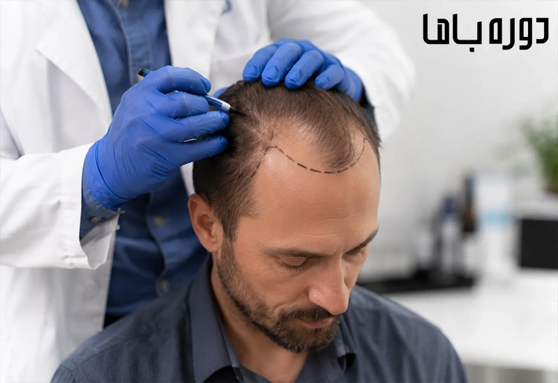 کاشت مو به روش تکثیر چگونه است؟ بررسی کامل مزایا، مراحل انجام