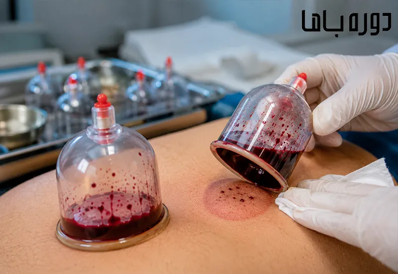 آیا می توان از روی خون حجامت بیماری را تشخیص داد