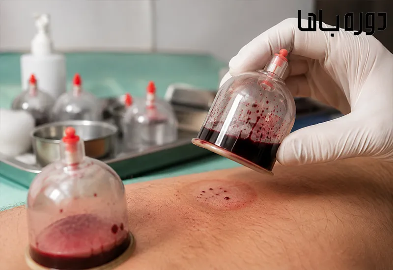 خون لخته در حجامت نشانه چیست؟ بررسی علت، رنگ خون و باورهای رایج