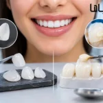 فرق لمینت و کامپوزیت چیست؟ بررسی کامل تفاوت‌ها، مزایا، معایب و ماندگاری