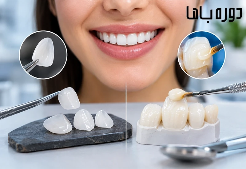 فرق لمینت و کامپوزیت چیست؟ بررسی کامل تفاوت‌ها، مزایا، معایب و ماندگاری